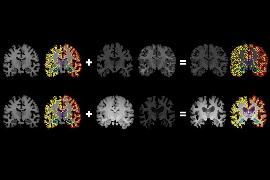 Segmentation IRM du cerveau par IA