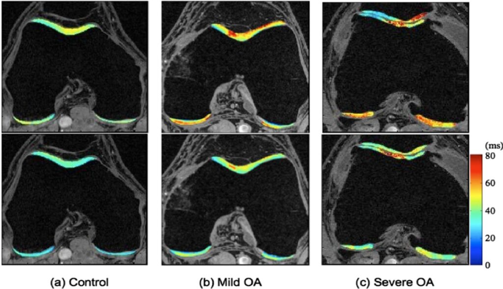 Example d’IRM quantitative sur cartilage articulaire